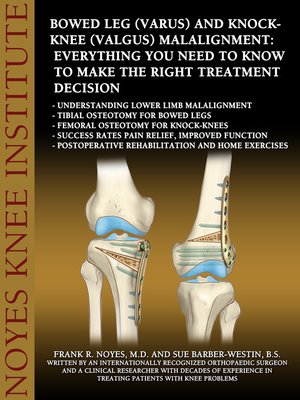 cover image of Bowed Leg (Varus) and Knock-Knee (Valgus) Malalignment